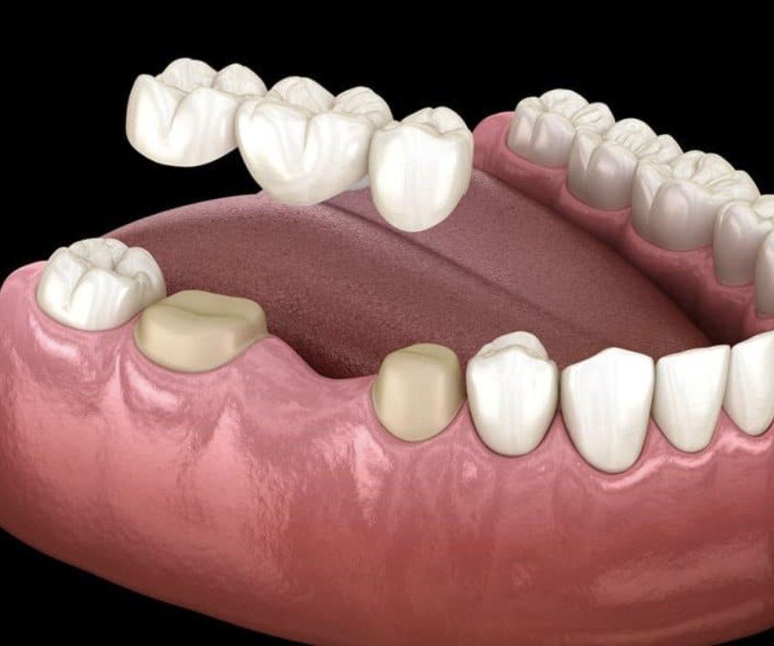 Dental bridge placed to replace missing teeth in Grayson